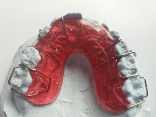 Die durchsichtige Zahnspange aus dem 3D Drucker